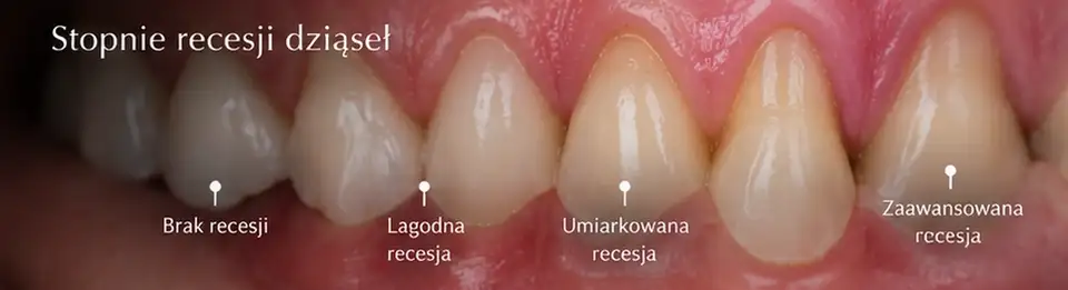 Poglądowe porównanie braku recesji dziąseł oraz niewielkiego, umiarkowanego i znacznego odsłonięcia korzeni zębów.